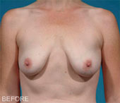 Patient # 91247 Before Photo # 1